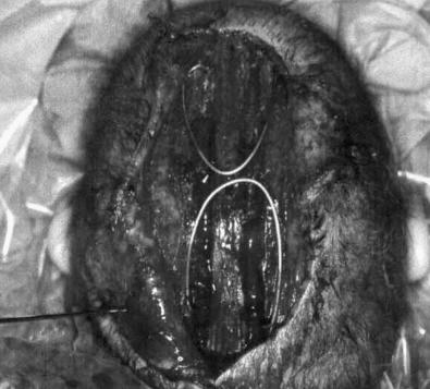 Figure 9.5, Spring-assisted cranioplasty for sagittal synostosis. Note the placement of two omega-shaped tension springs across the sagittal synostectomy defect.