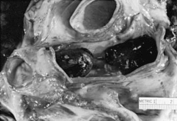 Fig. 24.4, A large embolus in the pulmonary artery, which was the cause of death.