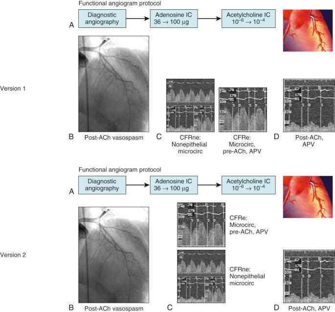 Fig. 38.1, Typical functional angiograms demonstrating changes in coronary flow reserve (CFR) in an endothelial-dependent (CFRe) and non–endothelial-dependent (CFRne) manner. The protocol, initiated with diagnostic angiography (A) and moving on to adenosine and acetylcholine (ACh) infusion, is depicted on top. The angiogram (far left) shows an example of vasoconstriction after the administration of ACh. (B) CFRne is assessed using blood-flow-velocity profiles ( APV , average peak velocity) at rest and after adenosine infusion (bottom middle). Assessment of CFRe is depicted on the far right (C) with a normal pre-ACh reading consisting of a predominant diastolic component on the top. The lower right panel (D) shows a marked reduction in APV after the infusion of ACh, indicative of poor microvascular recruitment of blood flow as seen in patients with microvascular disease. IC, Intracoronary.
