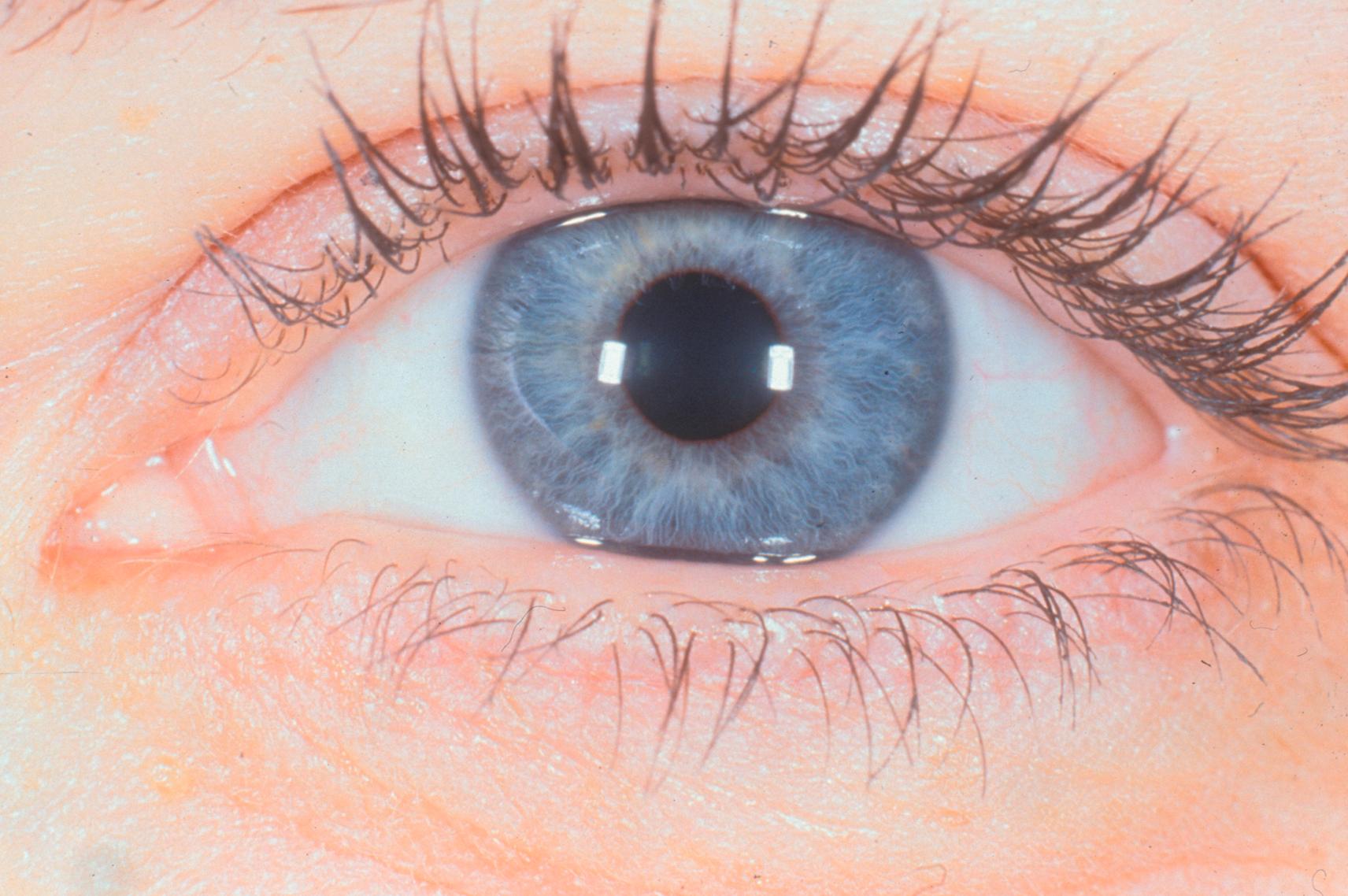 Figure 3.1, The normal lower eyelid rests at the inferior limbus.