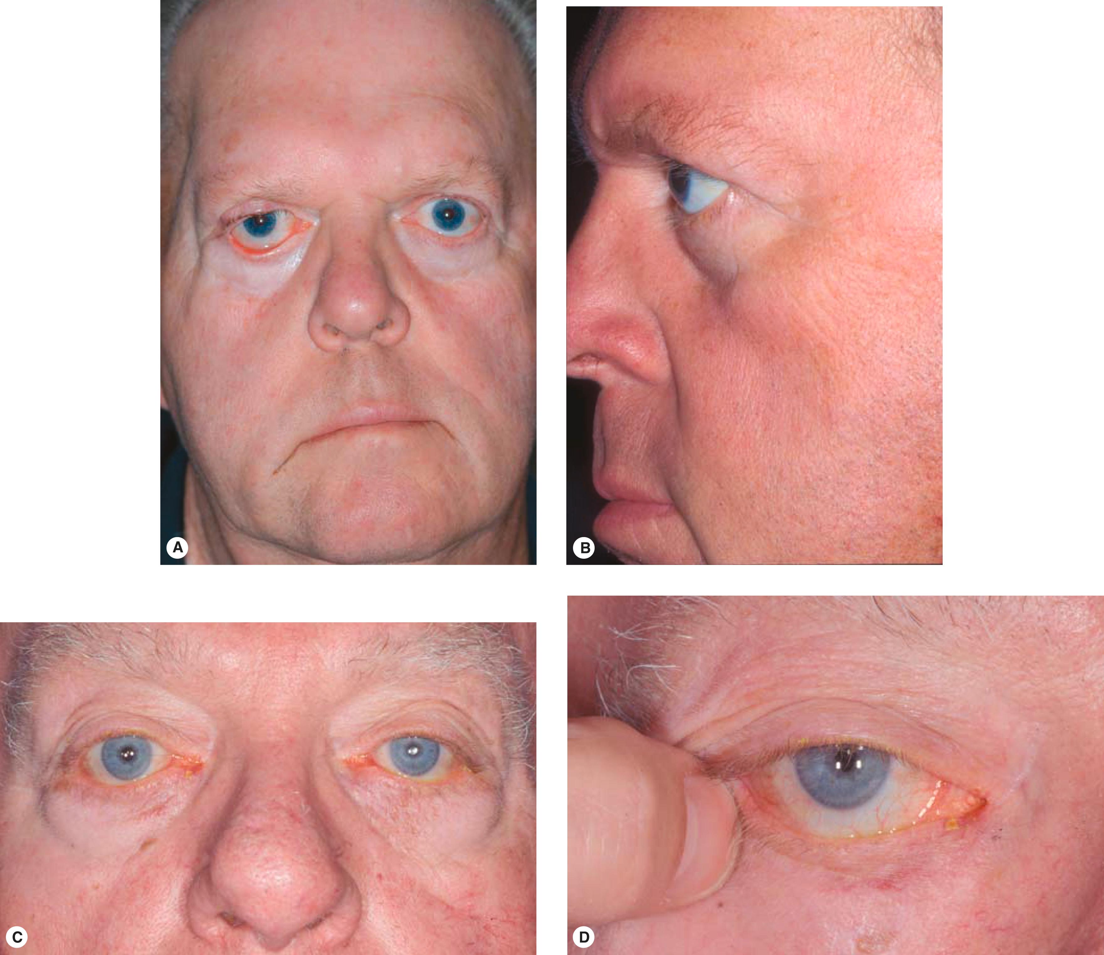 Figure 3.2, Hemiproptosis or hypoplastic midface, also known as a negative vector eyelid, associated with lid retraction. Facial nerve paralysis after parotidectomy. ( A ) Note lower eyelid retraction on both sides and ectropion of right lower eyelid. ( B ) Inferior orbital rim is posterior to the front of the globe, which complicates ectropion repair. ( C ) Note lower lid retraction in a second patient with hemiproptosis. ( D ) Simulated horizontal tightening of the lower eyelid increases the retraction.