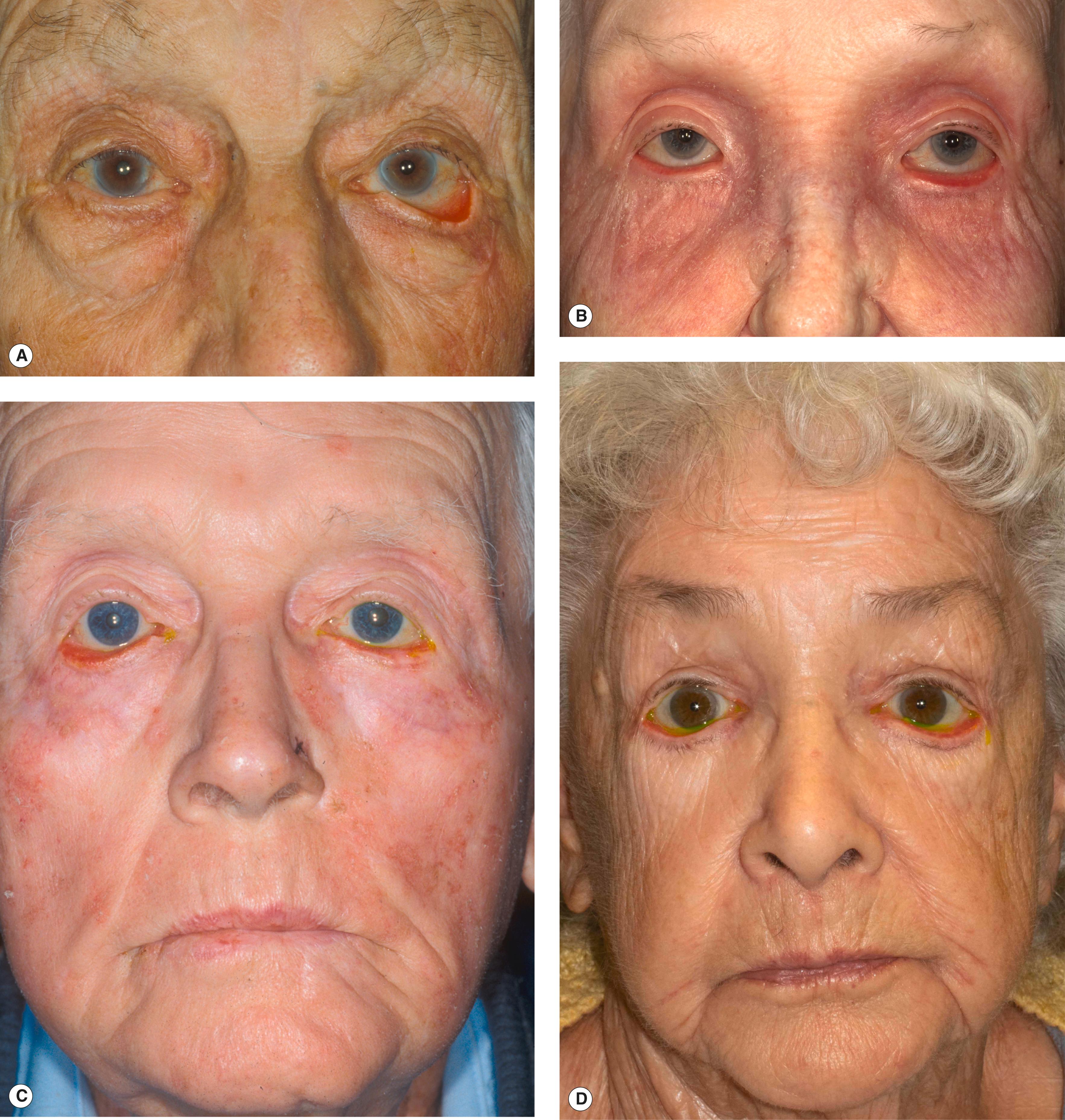 Figure 3.3, Cicatricial ectropion caused by anterior lamellar shortening. ( A ) Trauma to the skin over the zygoma, resulting in a scar that pulls the eyelid down. ( B ) Dermatitis due to latanoprost drops causing ectropion. The ectropion resolves with a change in medication. ( C ) Chronic sun-damaged skin causing a generalized tightness of the facial skin. In both cases, surgical correction requires lengthening of the anterior lamella, usually with a full-thickness skin graft and lower eyelid tightening. ( D ) Ichthyosis, a cicatricial skin disease. There are many types of ichthyosis. Medical treatment is the first line of therapy. Skin grafting may be required in severe cases, but often fails.