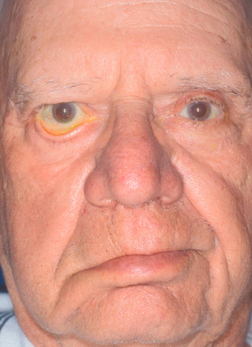 Figure 3.4, Paralytic ectropion caused by right facial nerve palsy. Note the flattened nasolabial fold and brow ptosis accompanying the ectropion.