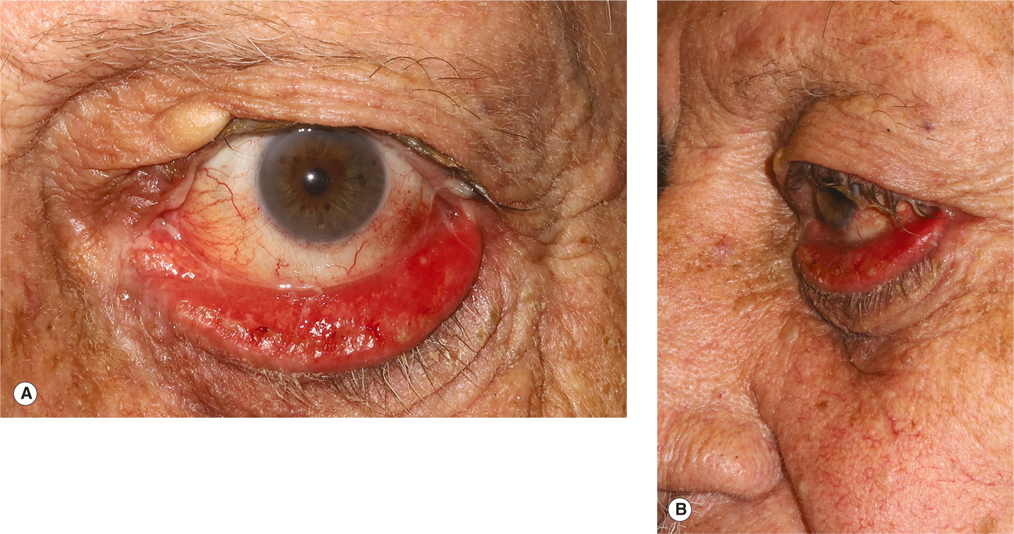 Figure 3.5, Tarsal ectropion often results from a combination of involutional and cicatricial changes. ( A ) The lower eyelid is completely everted, leading to an irritated eye with chronic drainage. ( B ) The horizontal eyelid laxity is complicated by the negative vector lower eyelid configuration.