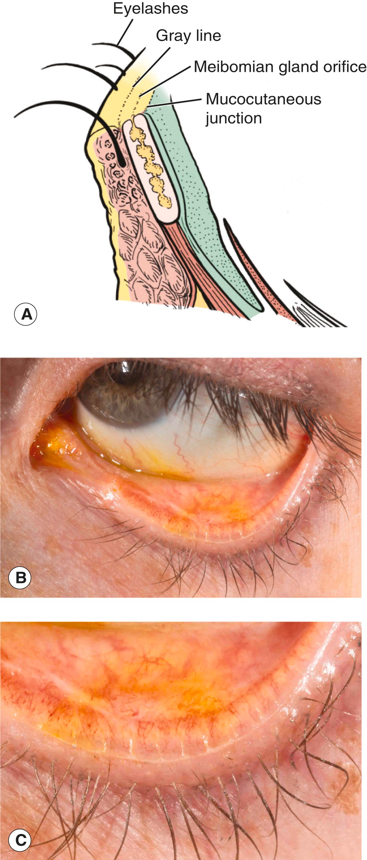 Figure 4.3, Eyelid margin architecture. ( A ) Normal eyelid margin. The lid margin is a flat platform with a sharp right-angled posterior edge. Normal landmarks (from posterior to anterior) are the mucocutaneous junction, meibomian gland orifices, gray line, and eyelashes. ( B ) Abnormal eyelid margin. This eyelid (manually everted) shows migration of the conjunctiva over the meibomian glands in the central area. The mucocutaneous margin has migrated anteriorly, a sure sign of long-standing entropion, usually cicatricial. A scar is present pulling the eyelid margin inward. ( C ) Close-up view of same eyelid. Notice that the mucocutaneous junction is now anterior to the meibomian glands. The gland openings appear as slits.