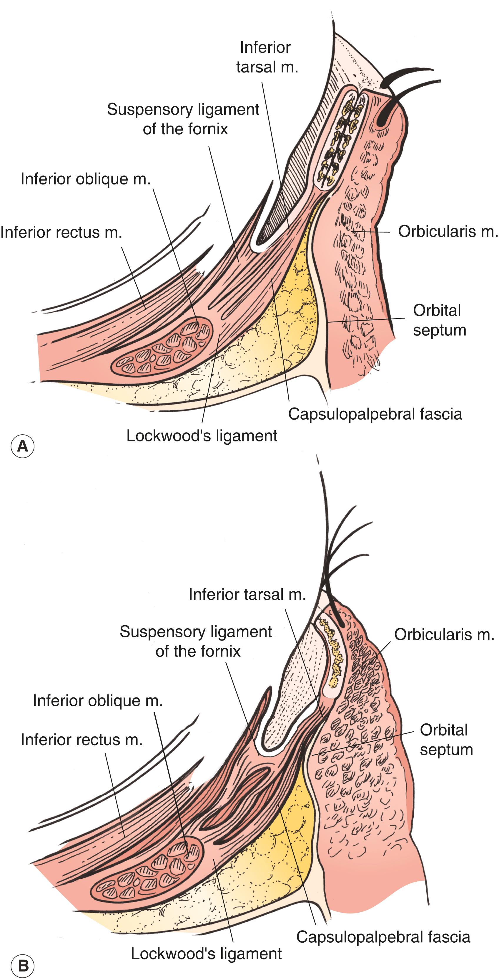 Figure 4.4, ( A ) Normal lower eyelid anatomy. The retractors pull the lower margin of the tarsus inferiorly and posteriorly, stabilizing the eyelid. ( B ) Involutional entropion: laxity of the lower lid retractors is the primary cause of involutional entropion.