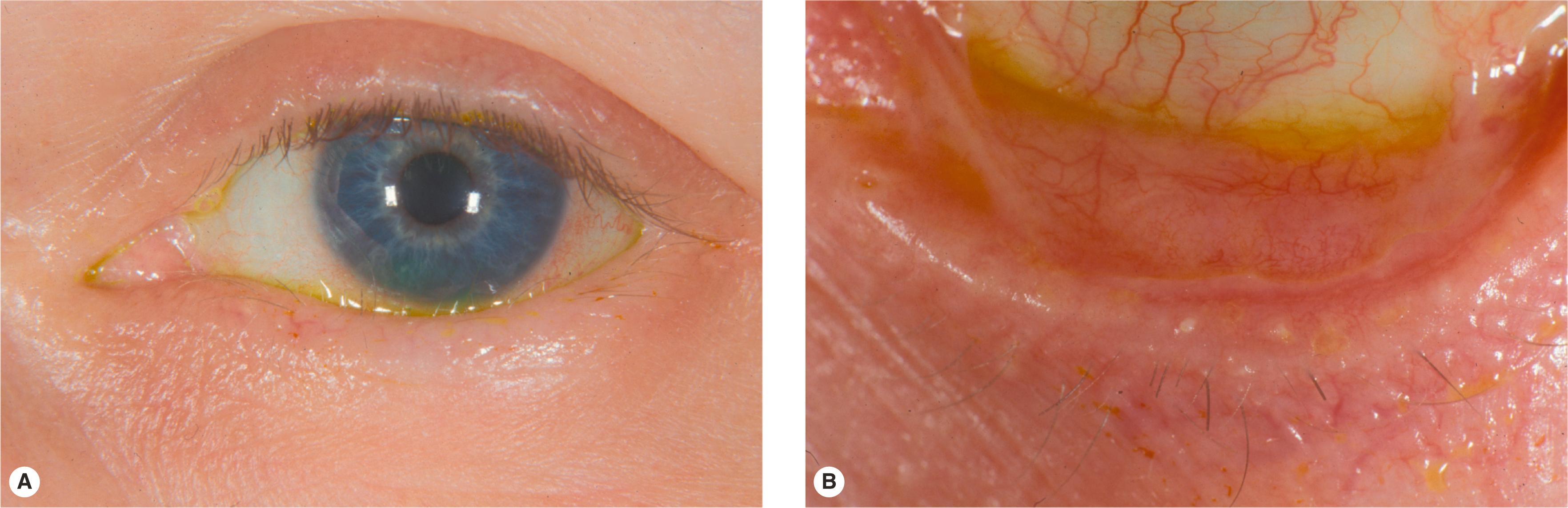 Figure 4.7, Mild cicatricial entropion caused by the Stevens–Johnson syndrome. ( A ) Note subtle inversion of eyelid margin. ( B ) Mild conjunctival scarring and shortening of the fornix are present. The scarring pulls the lid margin inward, causing the cicatricial entropion.