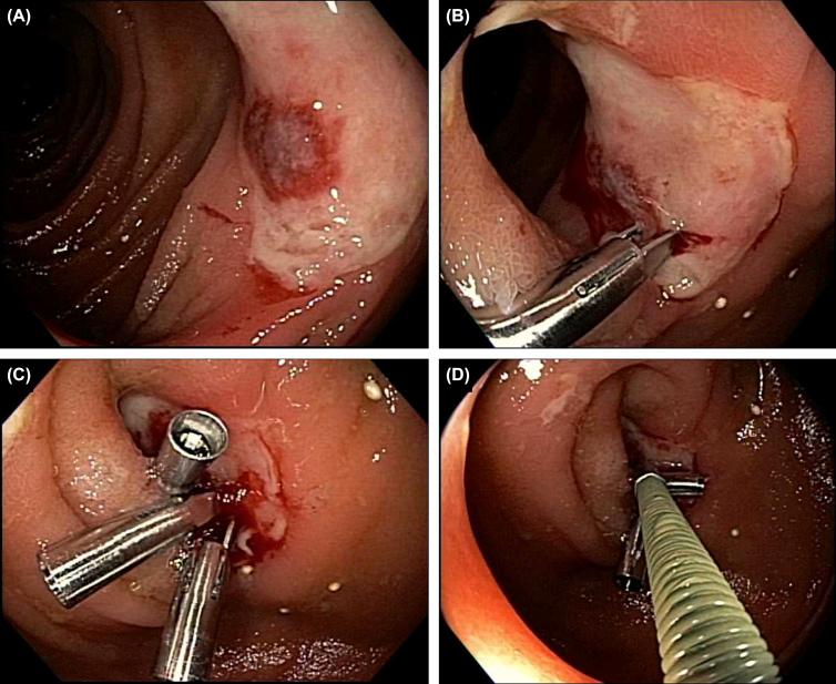 Figure 26.1, Large ulcer of the terminal ileum in Crohn's disease. (A) Discrete large ulcer with a visible vessel while the patient on biological therapy; (B and C) deployment of endoclips to the visible vessel; (D) subsequent injection of 50% glucose in the area.