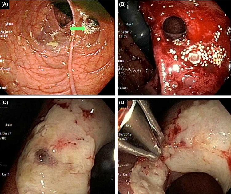 Figure 26.2, Bleeding from ileocolonic anastomosis from a diagnostic colonoscopy in a Crohn's disease patient. (A) The normal anastomosis ( green arrow ); (B) bleeding started by passage of a pediatric colonoscopy; (C) bleeding for another 48 h. Ulcer and a visible vessel seen on the anastomosis; (D) endoclips were used to treat.