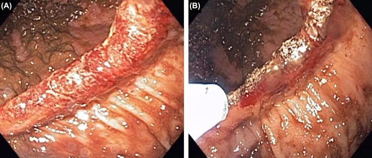 Figure 26.3, Ileocolonic anastomotic ulcer bleeding in Crohn's disease. (A) Anastomotic ulcer with bleeding; (B) application of argon plasma coagulation.
