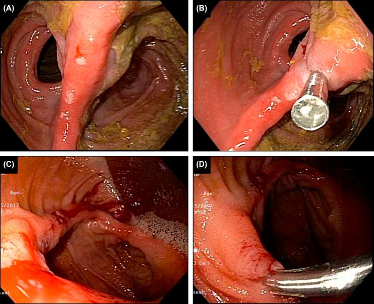 Figure 26.4, Bleeding from mid-ileal pouch staple line causing severe anemia in two patients. (A and B) Small inflammatory polyp along the staple line causing intermittent bleeding, controlled by endoclip; (C and D) staple line bleeding controlled by endoclips.