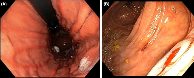 Figure 26.6, Concurrent ulcerative colitis and primary sclerosing cholangitis may increase the risk for bleeding in diagnostic and therapeutic endoscopy. (A) Portal hypertensive gastropathy indicative portal hypertension; (B) excessive bleeding after biopsy due to portal hypertension.