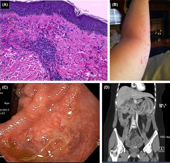 Figure 26.7, Concurrent ulcerative colitis and Henoch-Schönlein purpura. (A) Vasculitis on skin biopsy; (B) classic skin rash; (C) ileal pouch after colectomy; (D) diffuse small and large bowel wall edema.