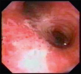 Fig. 17.1, Bronchoscopic view of the trachea from a patient with smoke inhalation injury. Note generalized inflammation and erythema. Edema is manifest as indistinct tracheal rings and blunting of the carina. There are patchy areas of denuded mucosa and a fibrinous exudate is forming at the carina