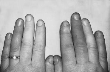 FIGURE 1, Discoloration of the fingers seen in Raynaud’s syndrome.