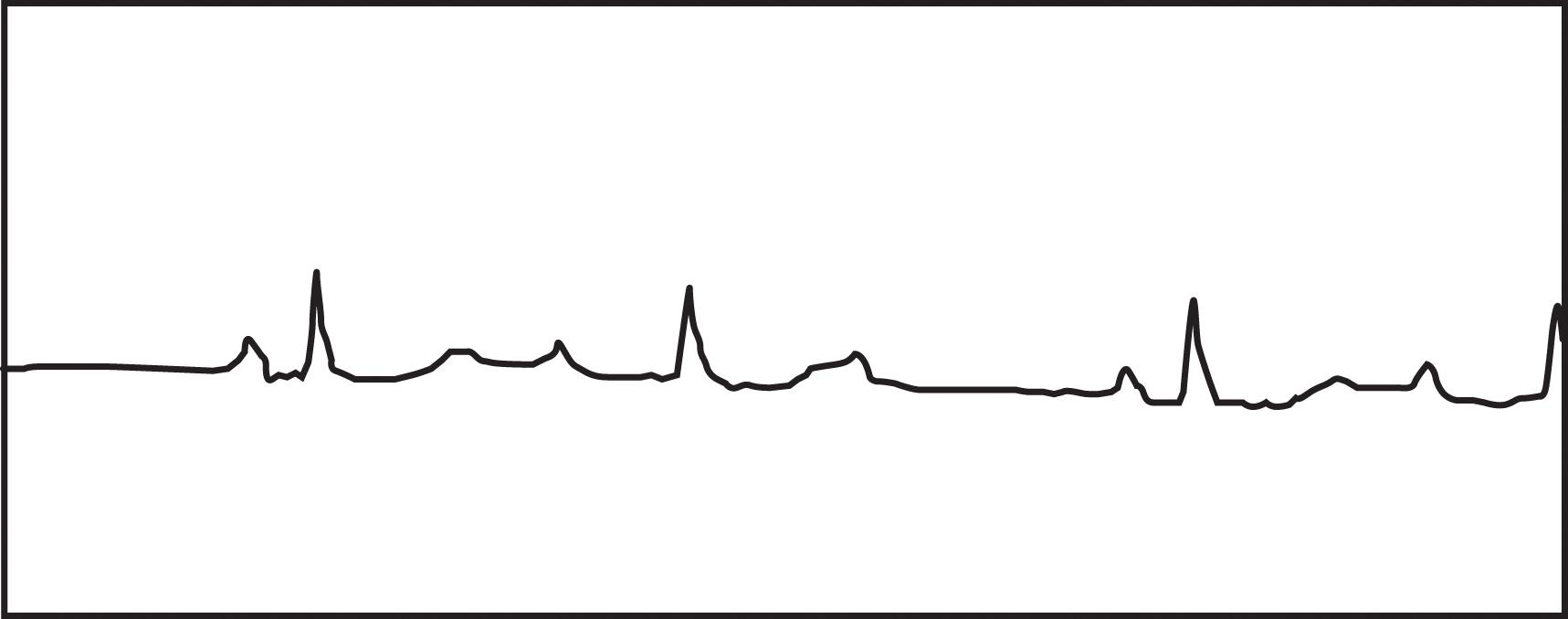 FIGURE 1, Rhythm strip shows progressive PR prolongation and a subsequent “dropped” QRS complex, followed by shortening of the PR interval which is diagnostic of Mobitz type I, second-degree atrioventricular block.