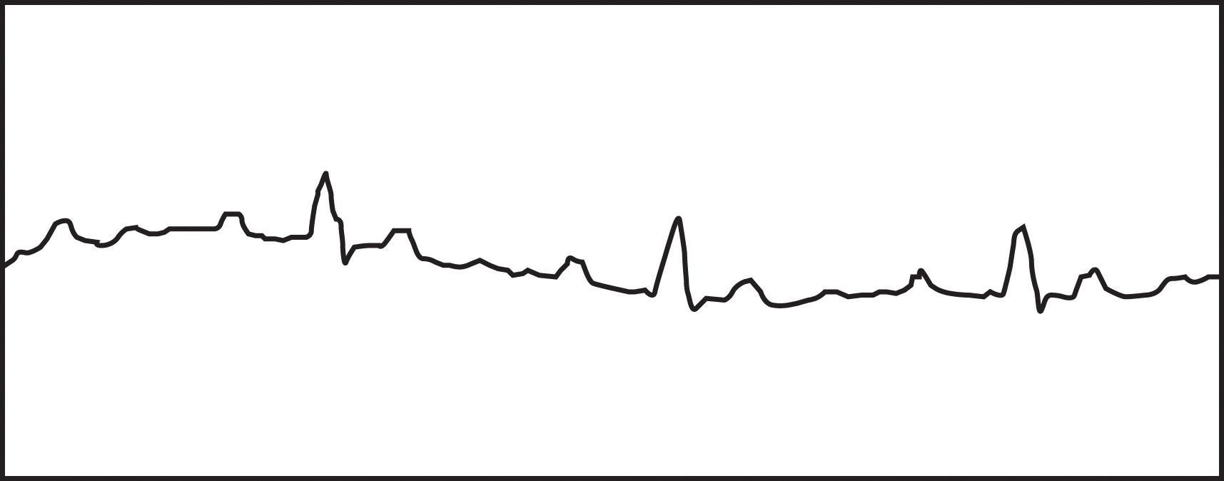 FIGURE 2, Rhythm strip shows atrial P waves and ventricular QRS complexes occurring at different rates and with no relationship between them, which is characteristic of third-degree atrioventricular block.