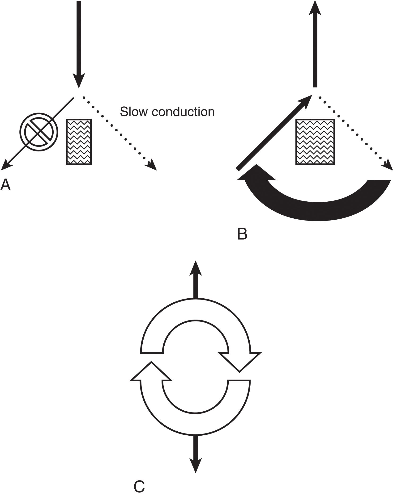 FIGURE 3, (A) Conditions required for reentry; two pathways separated by unexcitable tissue, unidirectional block, and slowed conduction. (B) Initiating factors allow retrograde conduction up the prior blocked pathway. (C) A reentrant circuit is formed.