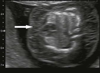 FIGURE 8-1, Gross fetal oedema (arrow) due to monosomy X.