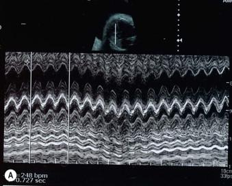 FIGURE 8-11, Two examples of a sustained fetal tachycardia.