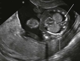 FIGURE 8-2, Pleural effusions (arrows) due to trisomy 18.