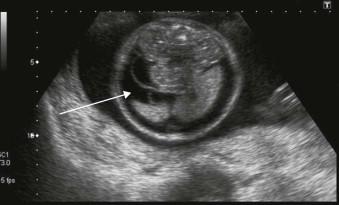 FIGURE 8-3, Fetal ascites (arrow) due to fetal infection.