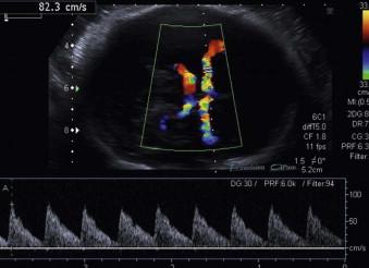 FIGURE 8-6, Raised PSV in a fetus at 20 weeks due to parvovirus infection (normal range at 34 weeks normal range at 34 weeks 48 cm/sec 1 MoM to 82 cm/sec 1.7 MoM).