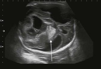FIGURE 8-7, Fetal intracranial haemorrhage (line arrow) indicates the acute echogenic bleed.