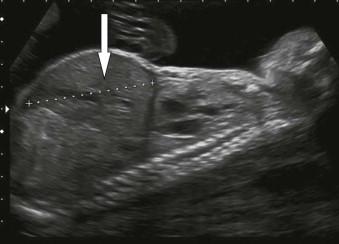 FIGURE 8-8, Enlarged liver (arrow) due to a transient myeloproliferative state in a fetus with trisomy 21 which produced anaemia at 32 weeks.