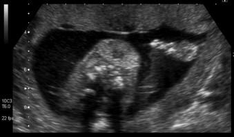 FIGURE 8-9, Fetal goitre seen in cross section of fetal neck.