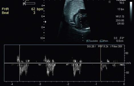 FIGURE 8-10, Fetal bradycardia at 30 weeks gestational age, fetal heart rate 62 bpm, there was an underlying structural defect.