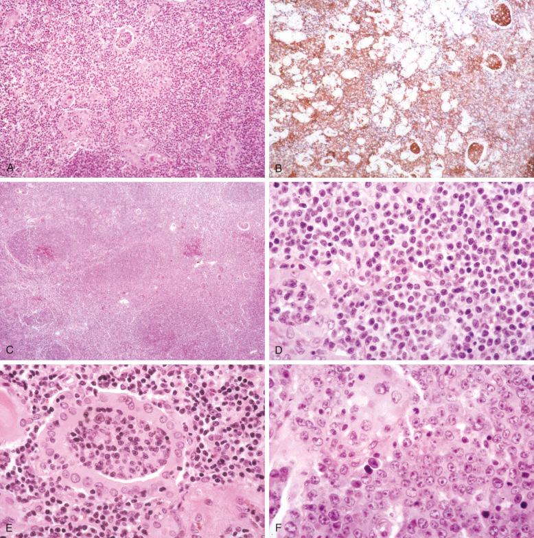 Figure 61-6, Thyroid gland with marginal-zone lymphoma (A to E) with large-cell transformation (F). Other areas showed Hashimoto's thyroiditis. A, Low power shows obliteration of the normal parenchyma. B, CD20 stain highlights the diffuse infiltrate of B cells; several rounded lymphoepithelial lesions are seen (immunoperoxidase technique on paraffin section). C, In some areas, there is vague nodularity, consistent with colonization of reactive follicles by neoplastic marginal-zone cells. D, The marginal-zone cells are small, with oval to slightly irregular nuclei and a moderate amount of pale cytoplasm. E, MALT-ball lymphoepithelial lesion. The epithelium of the thyroid follicle shows oxyphil change. F, An area of large-cell transformation. Many of the neoplastic cells are immunoblasts.