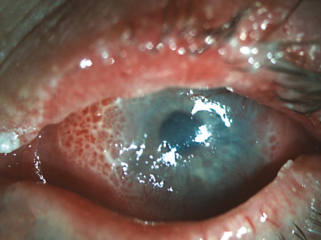 Figure 11.12, Advanced sebaceous cell carcinoma with eyelid thickening and obvious pagetoid spread. This patient requires an orbital exenteration.