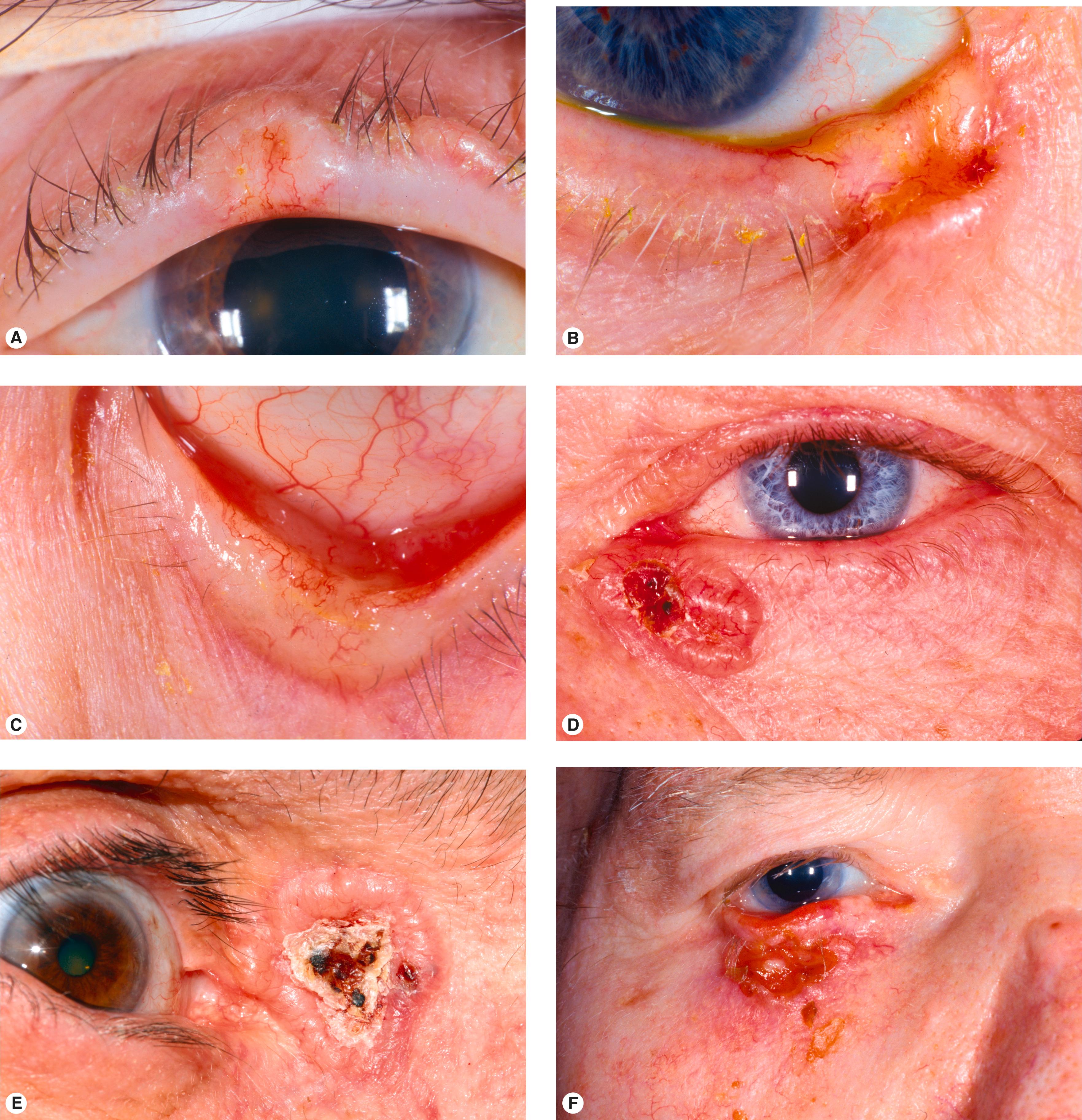 Figure 11.2, Typical examples of basal cell carcinoma. ( A ) Note the classic features—pearly margins and telangiectasias—in this small nodular basal cell carcinoma on the upper eyelid margin. ( B ) Pearly margins and an irregular shape are prominent in this basal cell carcinoma. Note the central ulceration and loss of the lid margin architecture. ( C ) This basal cell carcinoma is pearly white and has typical telangiectasias. Note the indurated thickening of the lid margin. The eyelashes are gone (madarosis), and the lid margin is altered. The tumor margins are not distinct in this example. ( D ) A more nodular basal cell carcinoma with distinct pearly margins, telangiectasias, and central ulceration. ( E ) Nodular basal cell carcinoma with crusting over central ulceration. ( F ) The most obvious feature of this basal cell carcinoma is ulceration. ( G ) Lower eyelid margin destruction. Punctum is ectropic. Note pearly margins and telangiectasia. ( H ) Upper eyelid margin destruction with obvious eyelash loss. Pearly margins and ulceration are present. ( I and J ) Morpheaform subtype of basal cell carcinoma. This type of basal cell carcinoma has less apparent clinical margins. These require a larger excision than you would expect! The telangiectasias in ( I ) and thickening of the skin strongly suggest a basal cell carcinoma and should prompt a biopsy. The sclerosing changes in ( J ) pulling the eyelids away from the eye suggest a biopsy. The defect after excision of these diffuse lesions may be large.