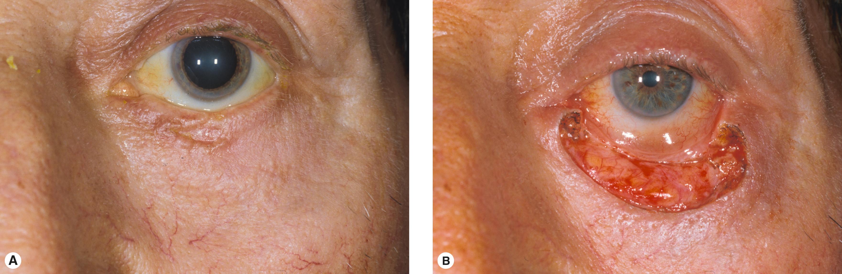 Figure 11.3, ( A ) Basal cell carcinoma with diffuse margins. Note light irises and weathered skin on cheek. ( B ) Large defect after excision.