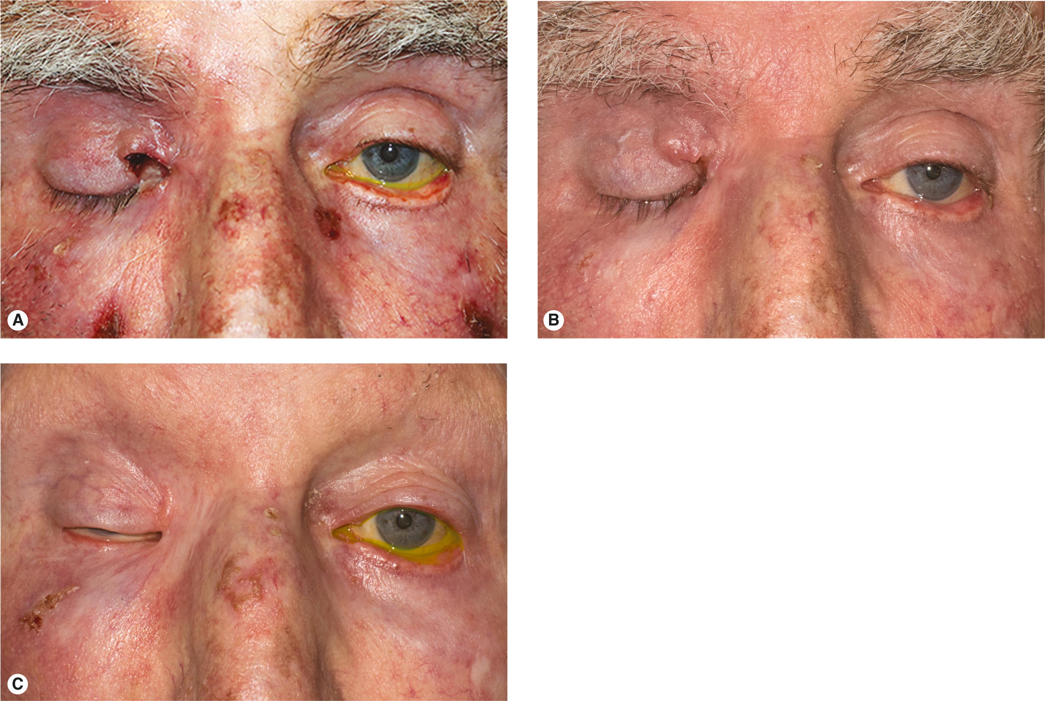 Figure 11.5, Advanced basal cell carcinoma treated with vismodegib. ( A ) Indurated ulcerated lesion with total ptosis. ( B ) After a few months of treatment the lesion is much smaller. Other skin lesions have cleared up. ( C ) After 9 months of treatment the surface ulceration has healed. The eyelid is scarred closed. The many other lesions on his face have cleared up. Hair loss and some malaise have resulted as side effects of the ongoing treatment.