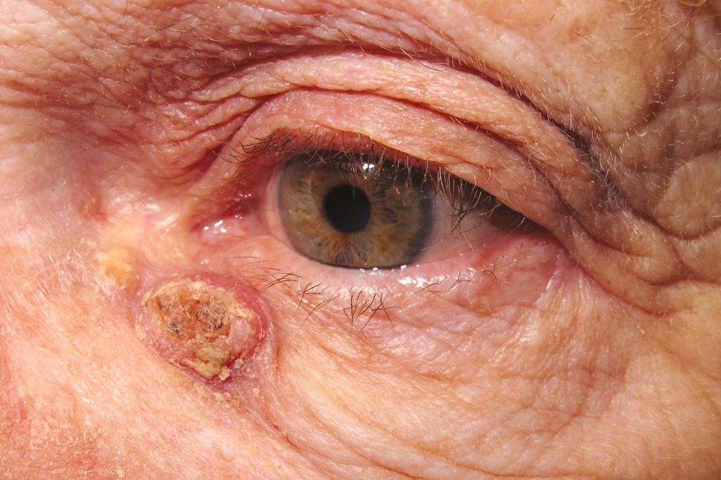 Figure 11.6, Squamous cell carcinoma. A malignancy is obvious in this indurated mass. The hyperkeratosis should suggest a squamous cell carcinoma, which was confirmed on biopsy.