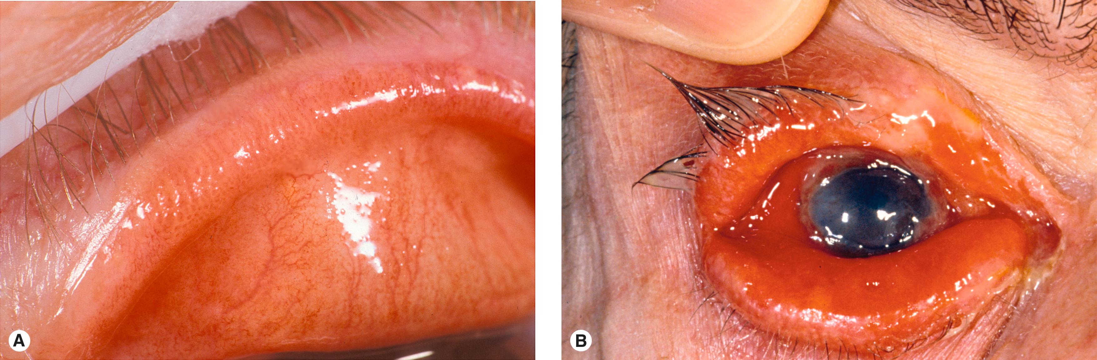 Figure 11.10, Sebaceous cell carcinoma. ( A ) The most common presentation is a subtle thickening of the lid margin. These lesions often have a yellowish hue. This is seen in thin lines along the eyelid margin, giving a tigroid appearance to the thickened tissue. ( B ) Advanced sebaceous cell carcinoma presenting as an advanced unilateral chronic blepharoconjunctivitis. Remember blepharitis is a bilateral disorder. Any unilateral blepharitis should have a biopsy.