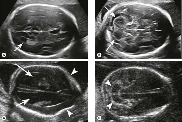 FIGURE 12-1, Axial views of the fetal head used for mid-trimester ultrasound screening of central nervous system malformations in the fetus. (A) Normal fetus at 21 weeks of gestation. The axial transventricular plane, cutting through the lateral ventricles (arrow), demonstrates absence of ventriculomegaly (atrial width less than 10 mm) and normal cerebral anatomy. (B) Normal fetus. The axial transcerebellar view demonstrates a normal posterior fossa, with an unremarkable cerebellum and a normal amount of fluid in the cisterna magna (arrows). (C) Fetus with open spina bifida at 20 weeks of gestation. The transventricular plane demonstrates clear moderate–severe ventriculomegaly (arrows) and scalloping of the frontal bones (arrowheads), the so called ‘lemon’ sign (from the shape of the fetal head). (D) Fetus with open spina bifida at 20 weeks of gestation. The transcerebellar plane demonstrates the Arnold–Chiari II malformation, with obliteration of the cisterna magna, and the abnormal shape of the cerebellum (‘banana’ sign, from its shape – arrowheads).