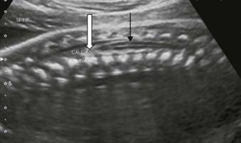 FIGURE 12-11, This sagittal view demonstrates the normal hypo-echoic spinal cord tapering to the level of the upper sacrum (black arrow) and its continuity with the echogenic cauda equina (block arrow).