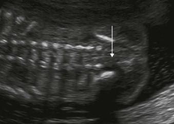 FIGURE 12-12, The sacrum may show incomplete ossification prior to 25 weeks' gestational age (the arrow indicates a poorly ossified spine at 22 weeks).