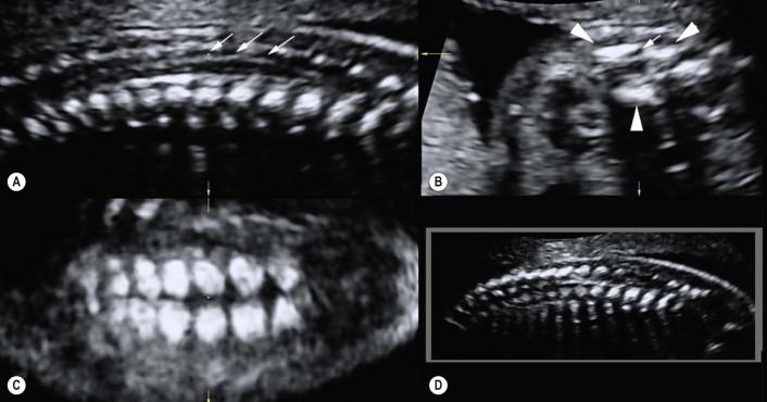 FIGURE 12-13, Three-dimensional ultrasound of the normal fetal spine at 22 weeks of gestation. In (B), a magnified axial view of a lower thoracic vertebra is shown.