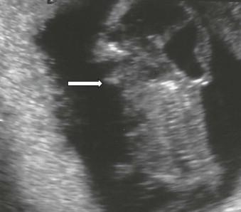 FIGURE 12-15, Upward-turned face and mandibular skin directly continuous with that of the chest due to the lack of neck (arrow).