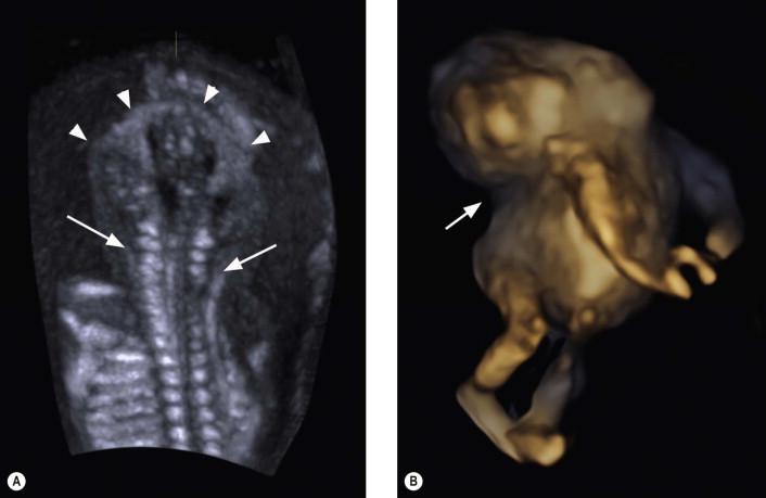 FIGURE 12-16, The fetal occiput will be adjacent to the thoracic spine ((A) arrowheads at the fetal cranium and the line arrows indicate the fetal thoracic spine), the face will be upturned and the mandibular skin will be directly continuous with that of the chest due to the lack of neck ((B) the line arrow indicates the lack of a fetal neck).