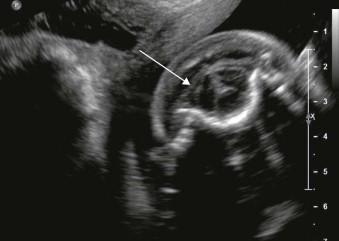 FIGURE 12-2, A TV scan of a 20-week fetus with an open neural tube defect. The degree of distortion and descent of the cerebellum (arrow) could only be seen transvaginally due to shadowing from the occipital bones.