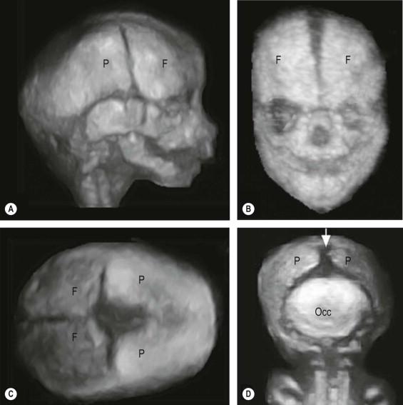 FIGURE 12-3, Three-dimensional ultrasound enables clear visualization of cranial bones, sutures and fontanelles. (A) Lateral view of the fetal head showing the coronal suture and the mastoid and temporal fontanelles; (B) frontal view of the fetal head, demonstrating the frontal bones (F), the metopic sutures, and all the facial bones; (C) the fetal head seen from above, showing the anterior fontanelle; (D) posterior view of the occipital region, showing the posterior fontanelle (arrow) and the sagittal suture. F: frontal bones; Occ: occipital bone; P: parietal bones.