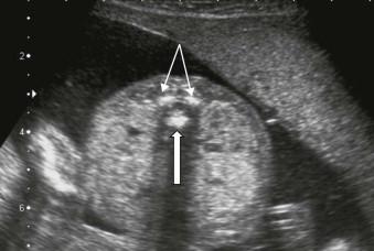 FIGURE 12-4, Each vertebral body has three ossification centres: one in the body (block arrow) and one at the base of each transverse process (line arrows) as seen on this transverse scan of the upper lumbar spine.