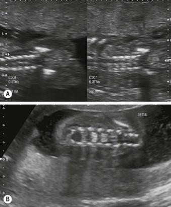 FIGURE 12-5, (A and B) Within the neural arches of the lumbosacral region ossification progresses caudally at a rate of one vertebral level every 2 to 3 weeks after 16 weeks. Compare this 16-week coronal spine (A) to a 20-week coronal spine (B) in terms of the degree of ossification.