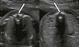 FIGURE 12-6, Axial view of the ossification centres, the two posterior elements converge towards each other to form an arch (arrows) which is very well appreciated in the prone fetus with its back to the transducer. Note the integrity of the overlying skin.