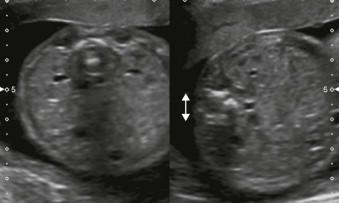 FIGURE 12-7, The fetus lying decubitus will appear to have posterior elements that are in parallel to each other.